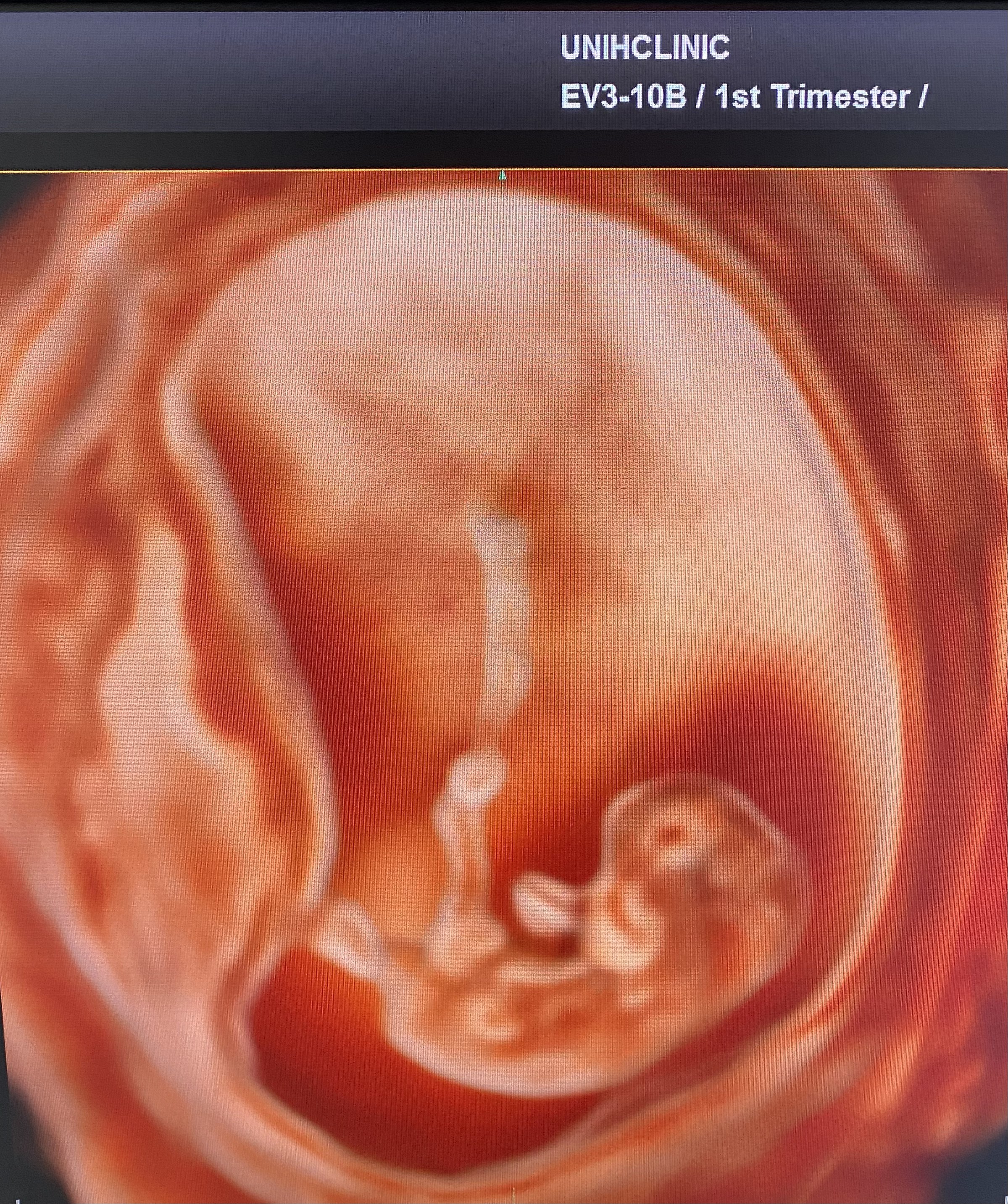 Ultrassom 3D do bebê em fase inicial de gestação