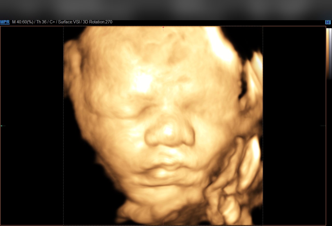 Ultrassom 4D em alta definição do rosto do bebê